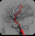 Electrodes for the Brain
